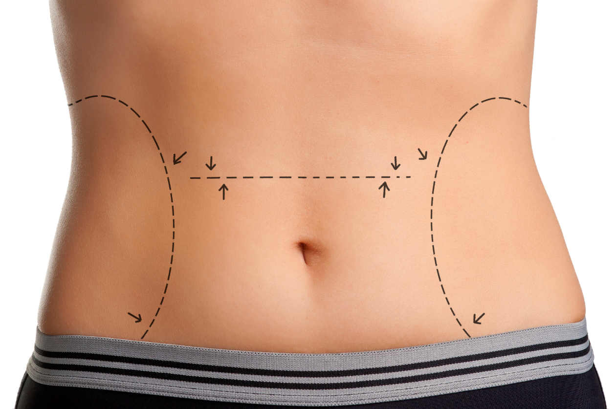 Preguntas frecuentes sobre la abdominoplastia o cirugia estetica del  abdomen